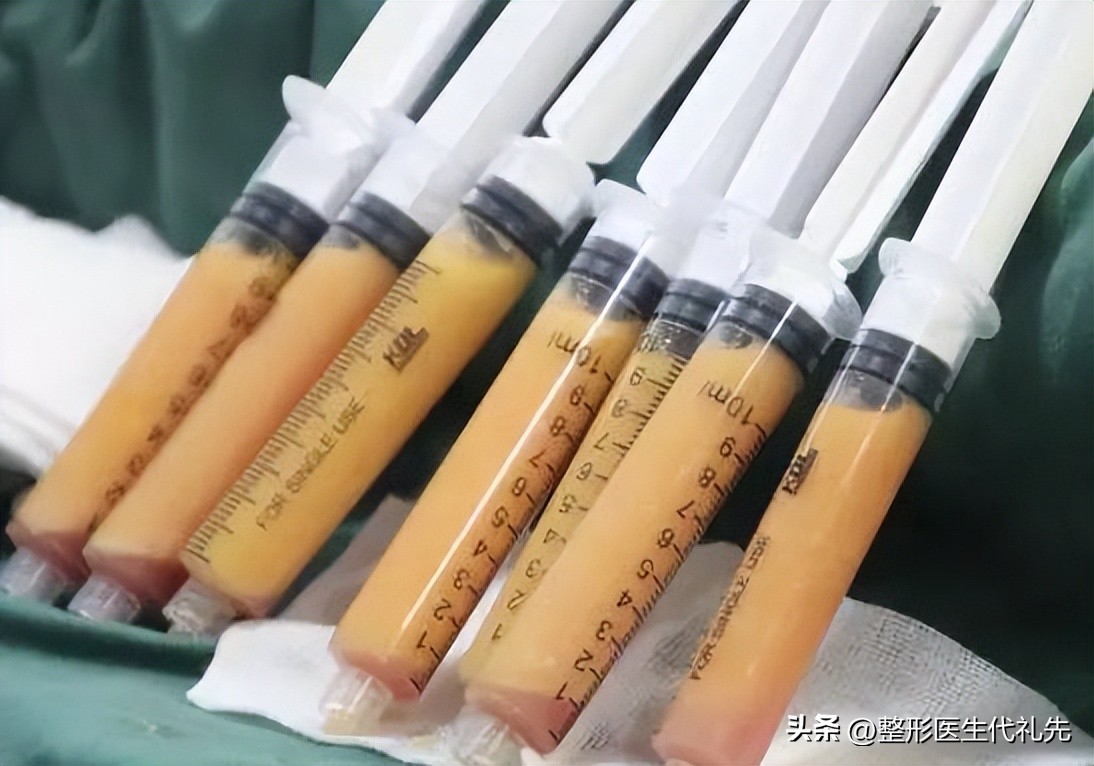 脸部填充哪个部位会显得年轻好看,宽脸适合面部脂肪填充