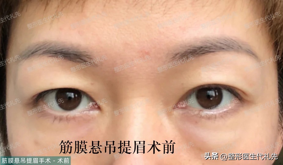 45岁女性做提眉手术多久能恢复,40岁做提眉手术的视频