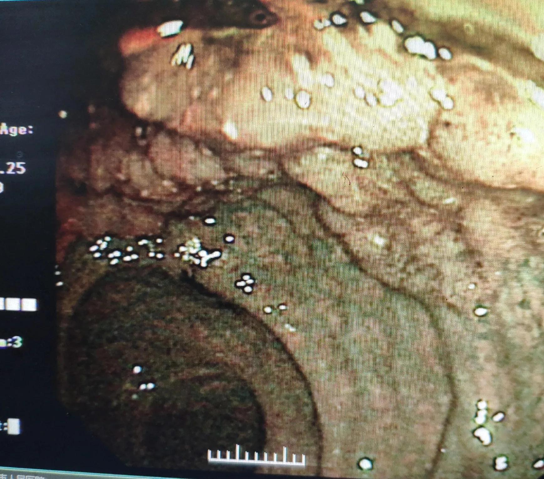 esd手术后续身体感觉,esd手术可靠吗