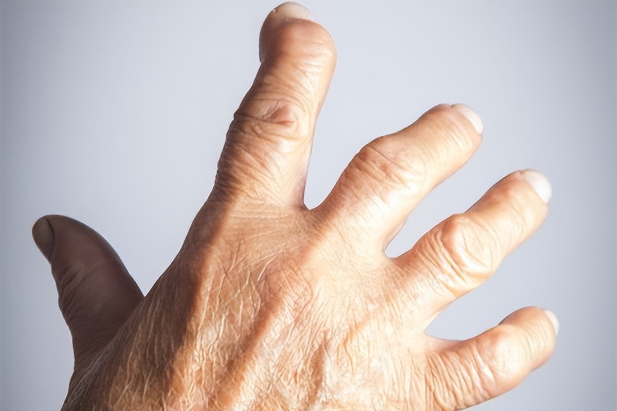 风湿类风湿关节炎如何缓解疼痛,全身关节疼痛风湿病要怎么治疗