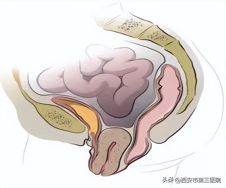 女性盆腔器官脱垂的症状,盆腔器官脱垂有哪些症状