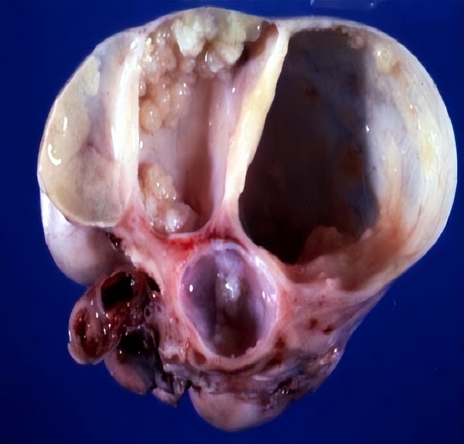 卵巢囊肿超声穿刺手术怎么做的,黄体囊肿与卵巢囊肿的超声区别