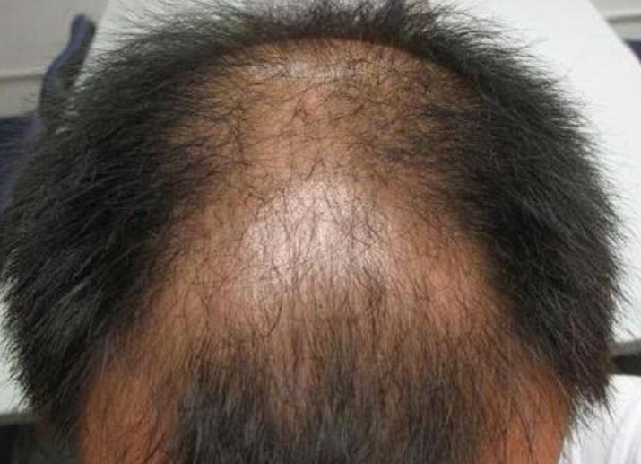 头皮痒抠出白泥是怎么回事,头皮抠出白泥头皮瘙痒如何治疗