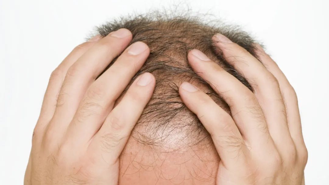 生姜擦头皮专治各种脱发视频,生姜擦头皮别乱用民间偏方危害大