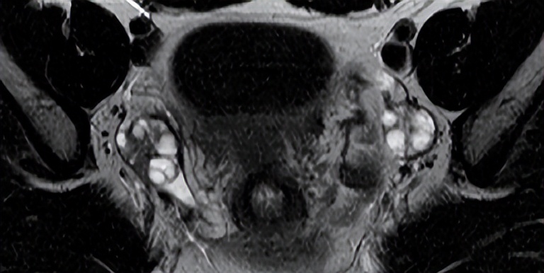 卵巢病变需要做什么检查,卵巢巧克力囊肿磁共振表现