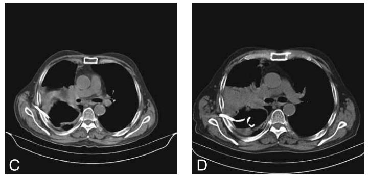 肺脓肿导管引流,肺脓肿的引流管脱落怎么办