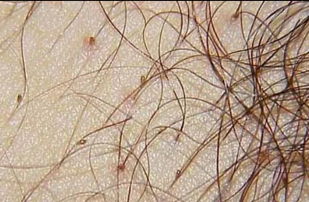 阴虱是什么？为什么现在很多人得阴虱？医生：离不开3个传播途径