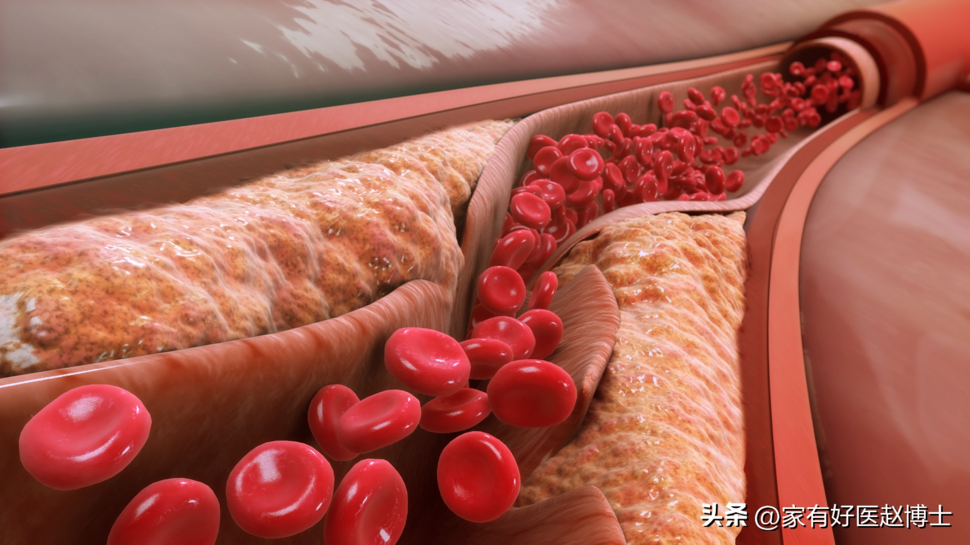 低密度胆固醇ldl偏高需要注意什么,hdl胆固醇偏低是什么意思