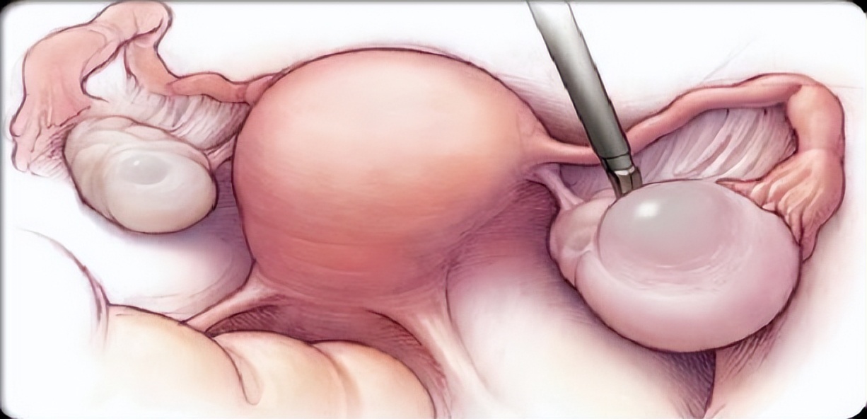 宫腔镜科普系列,宫腔镜和腹腔镜哪个比较好