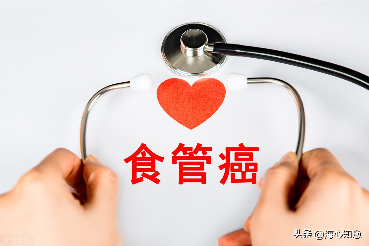 食管癌不手术姑息化疗几天,食管癌晚期姑息治疗方案