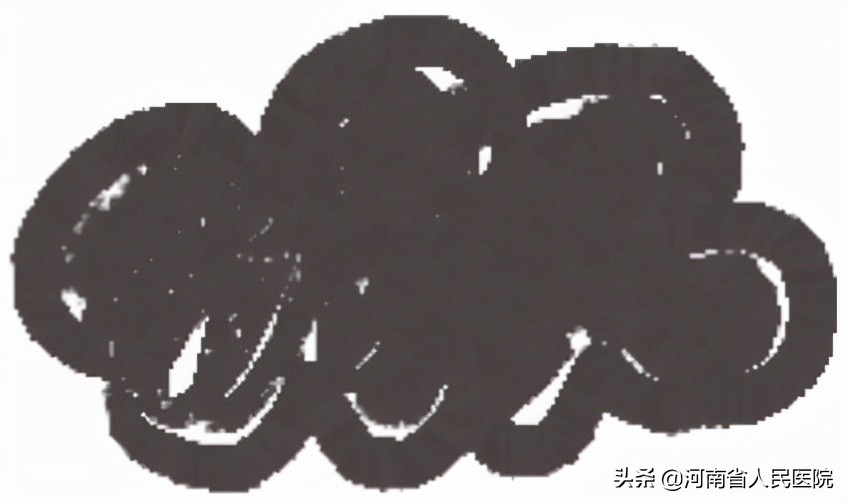 “因为这只手，孩子躲着我走”