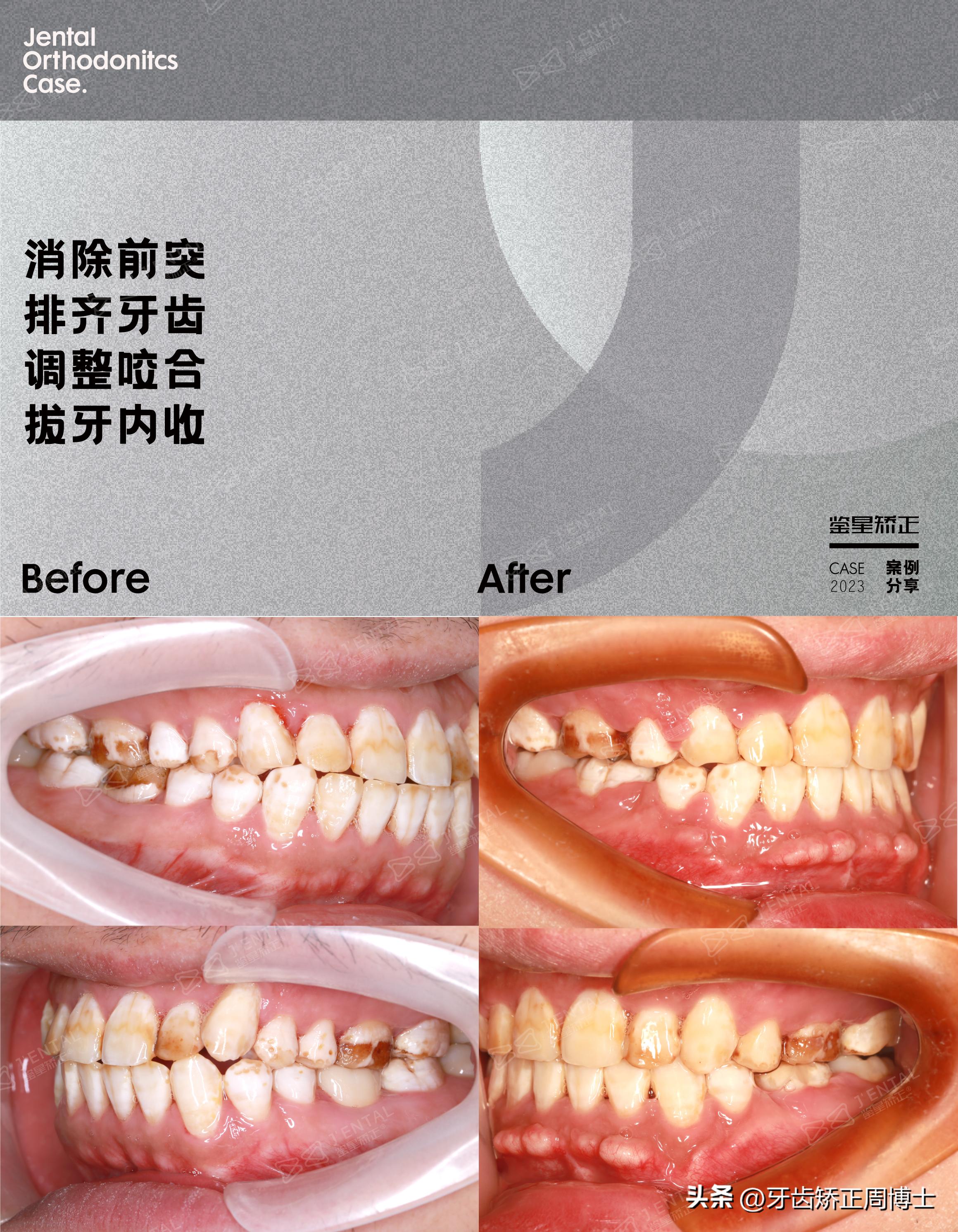 智齿正畸替代第二磨牙危害,智齿矫正代替第二磨牙3d图