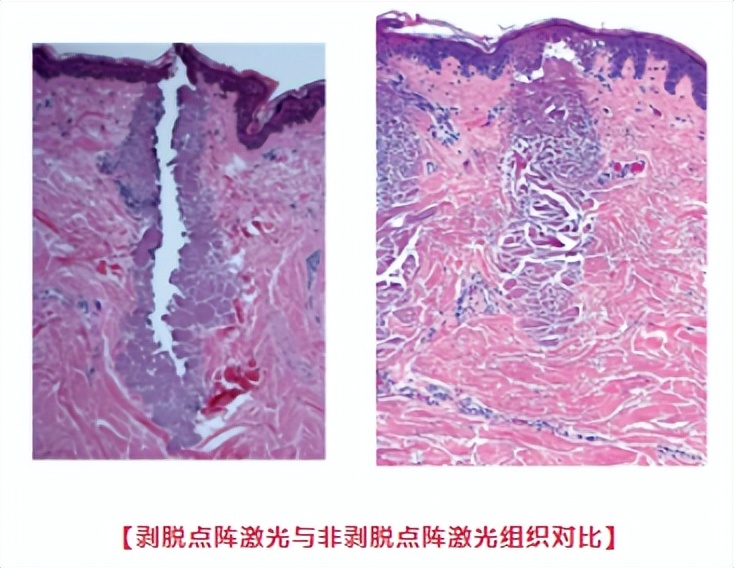 医学那么发达为什么治不了痘坑,想治痘坑但没钱怎么办