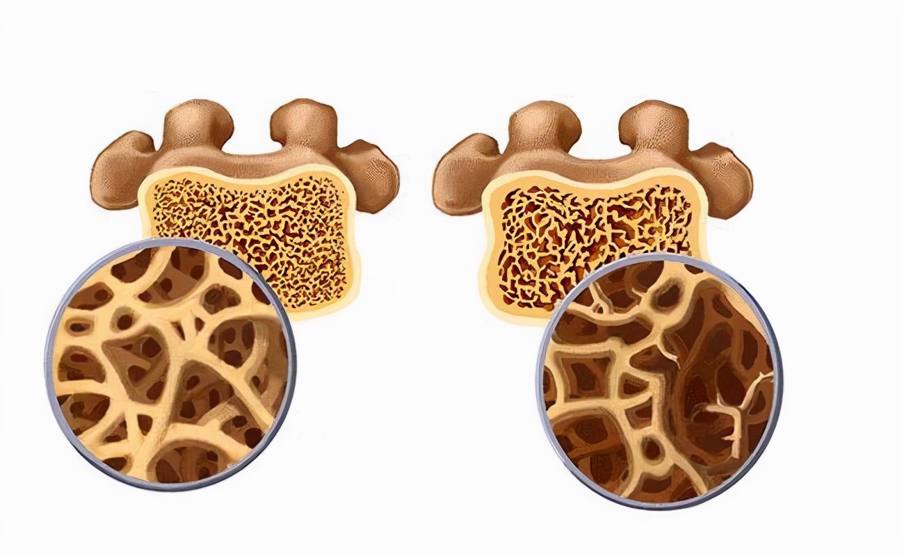 骨骼一碰就碎是什么病,骨骼一碰就碎