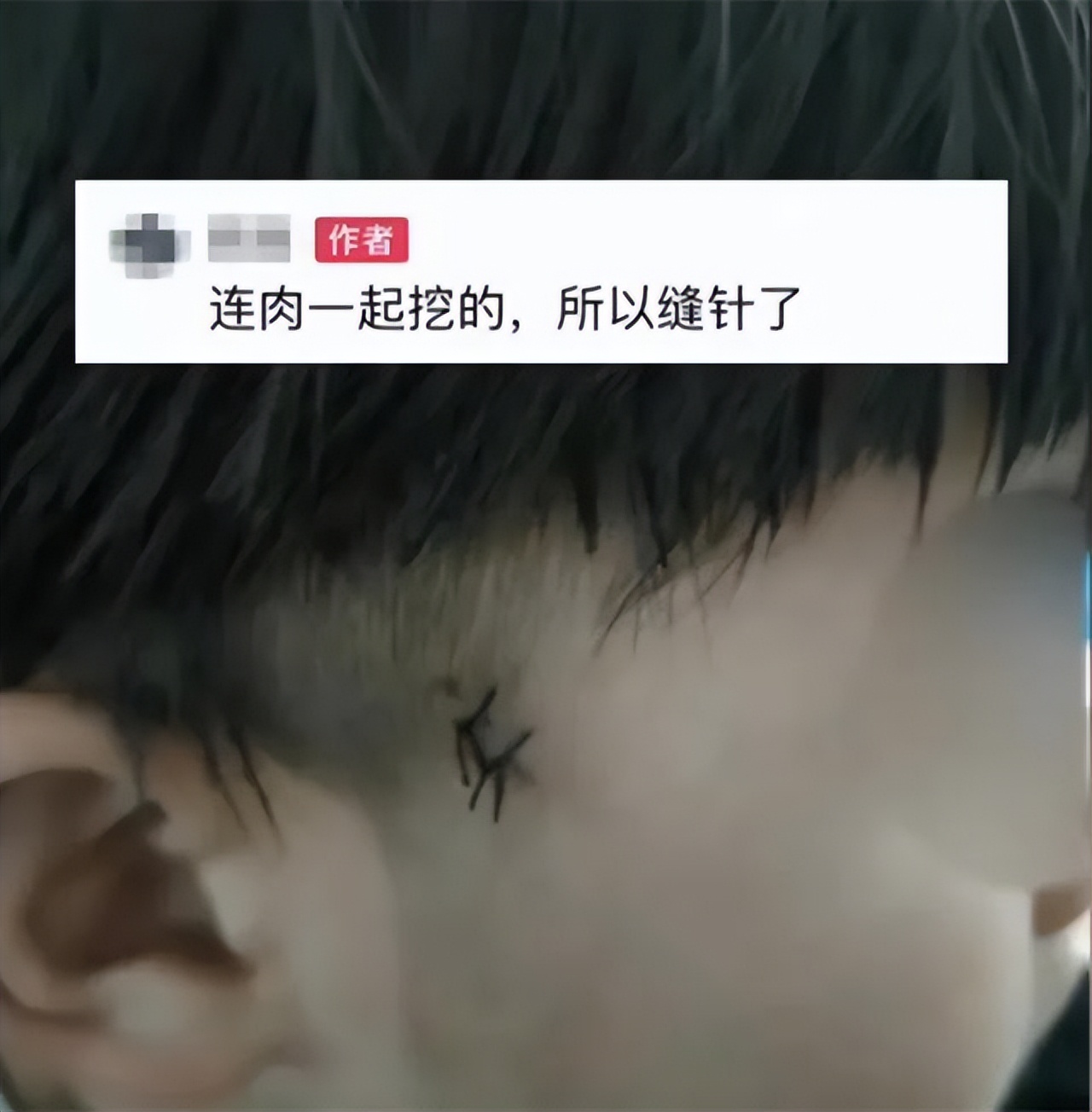 妈妈帮孩子理发发现蜱虫,小孩儿头上发现有蜱虫