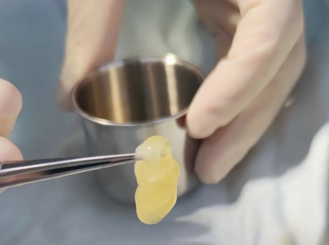 伤口溃脓可以自愈吗,溃烂化脓的伤口怎么愈合快