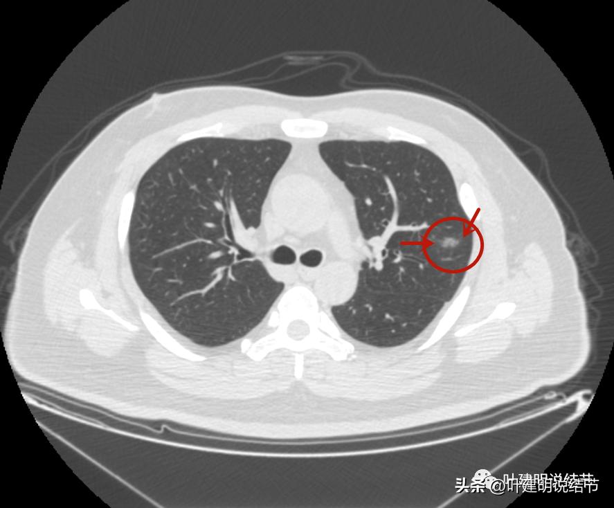 如何判断肺磨玻璃结节是高危结节,肺上有混合磨玻璃结节要注意什么