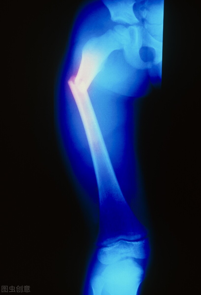 儿童股骨骨折手术全过程,小孩股骨骨折保守治疗还是手术