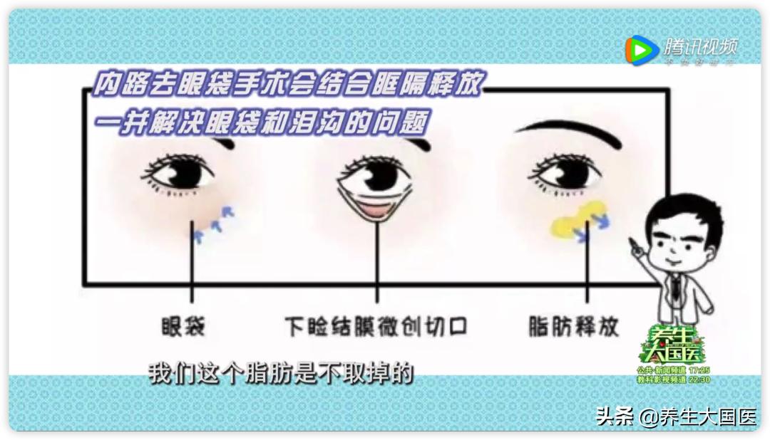 对付眼袋有良方,中年人的眼袋2分钟解决