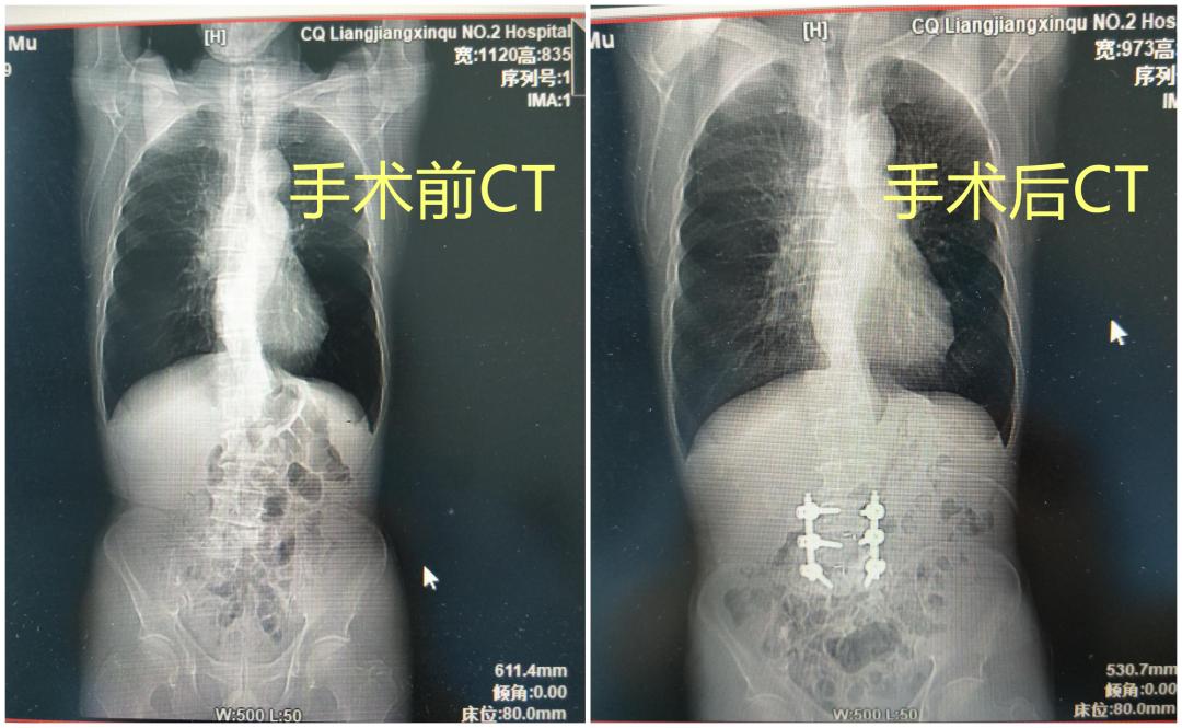 古稀老人腰椎间盘突出疼痛难忍,这个手术助其康复