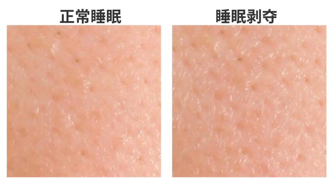 熬夜显老了怎么恢复,18岁熬夜脸部衰老怎么改善