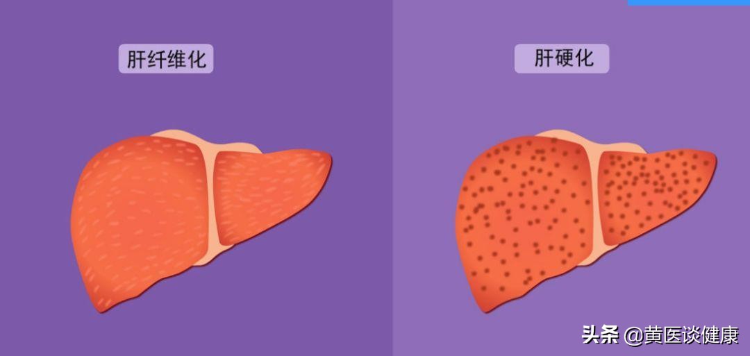 有肝癌家族史后代要打加强针吗,有家族肝癌史患者要抗病毒治疗吗