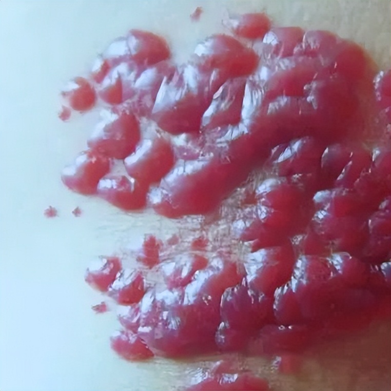 新生儿有胎记,新生儿身上有胎记怎么处理