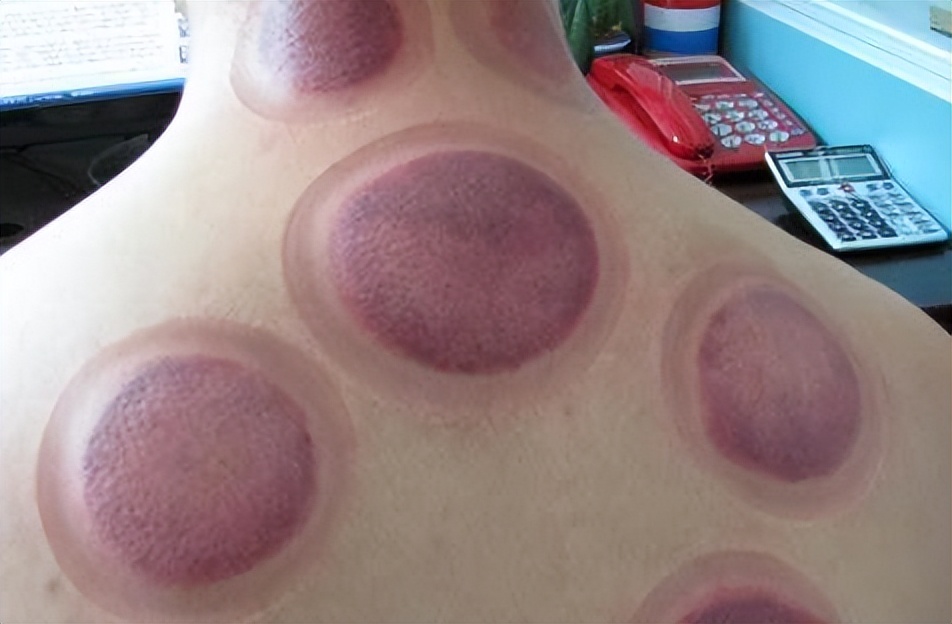 拔火罐吸出来的是湿气还是毒素,拔火罐时吸出的淤血是毒素吗