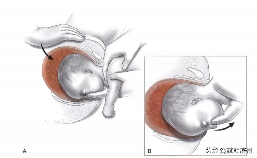 臀位助产必须在几分钟内娩出胎头,臀位剖腹产妈妈危险吗