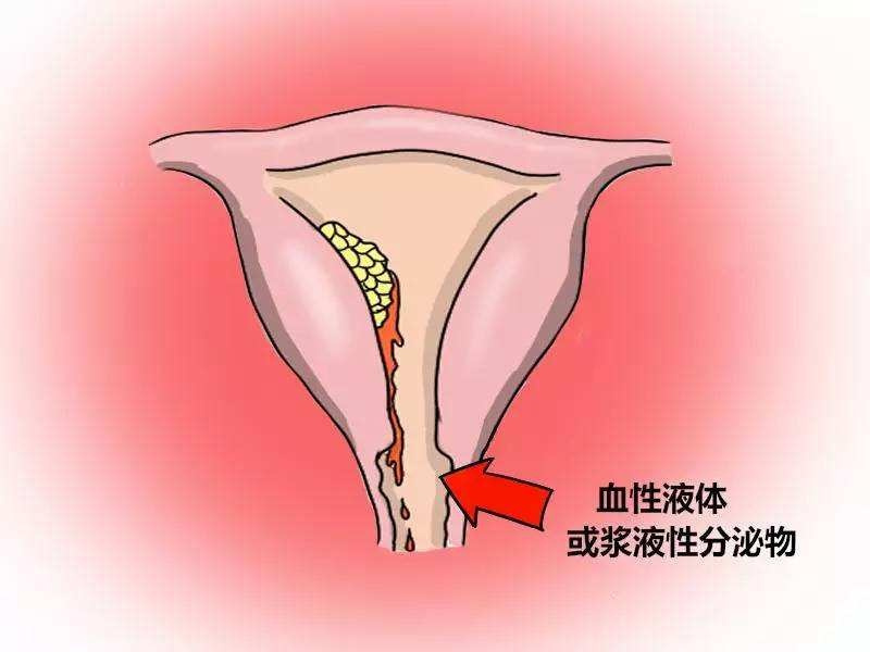 绝经后少量出血是患妇科癌症吗,绝经后出血并有hpv51阳性怎么治疗