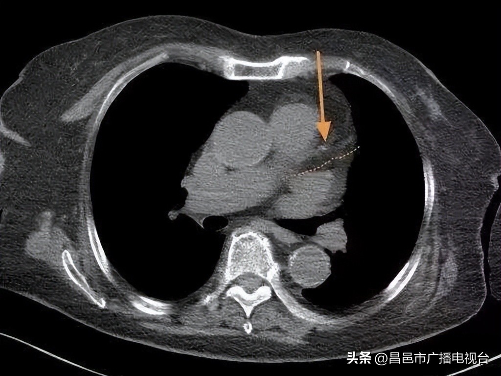 心血管堵塞80岁老人怎么治疗,90岁老人心血管疾病暴增