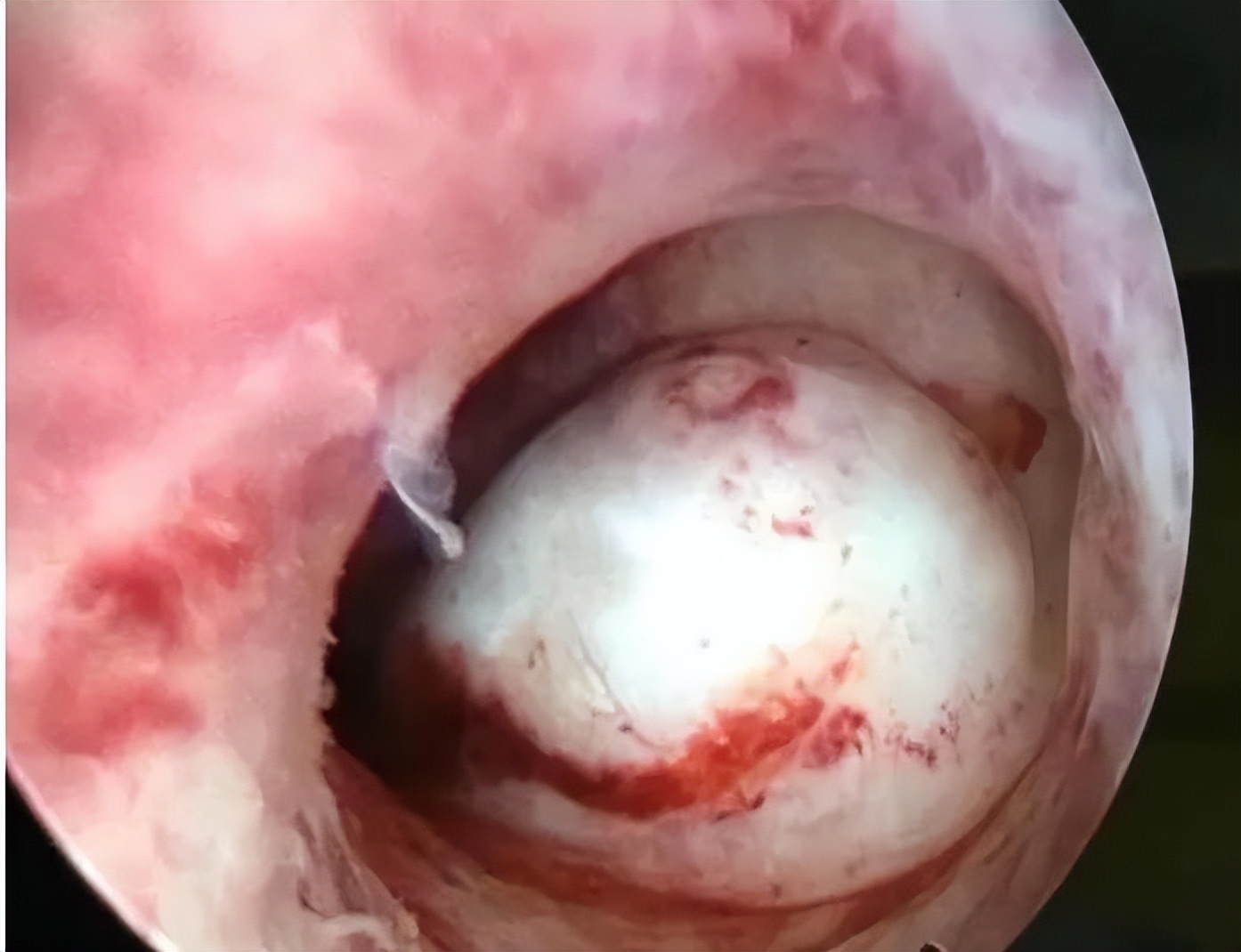 妇科医生5分钟小科普,门诊宫腔镜科普文章