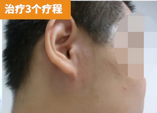 白癜风治愈的最佳方法,白癜风做308分子激光能彻底治愈吗