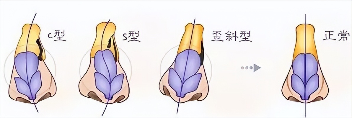 北京八大处整形医院歪鼻矫正,北京同仁医院鼻科知名专家排名