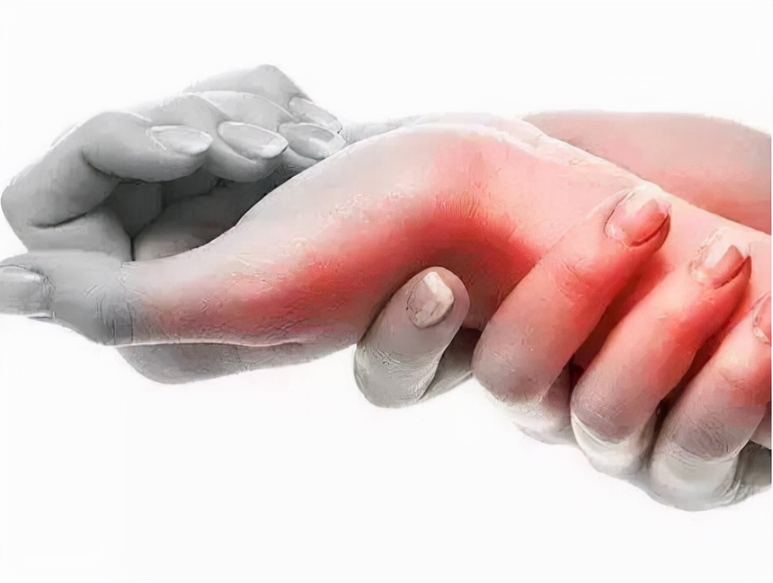 更年期女性手指腱鞘炎,女性绝经易患屈指腱鞘炎吗