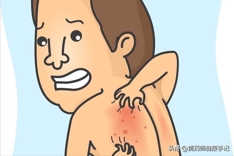 治皮肤瘙痒用什么中药能止痒,湿疹荨麻疹中草药止痒膏