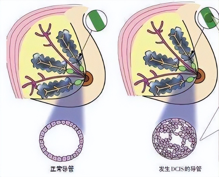 乳腺导管原位癌her2阳性如何治疗,乳腺导管原位癌微浸润治疗