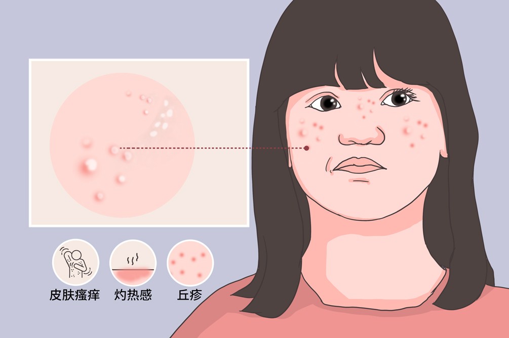 毛发上皮瘤的症状有哪些,毛发上皮瘤是怎么形成的