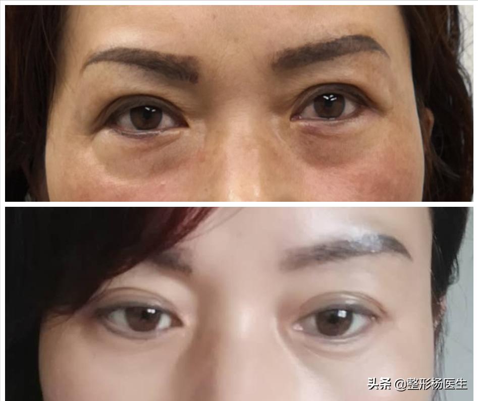 眼袋手术后真的显年轻吗,割眼袋能年轻几岁