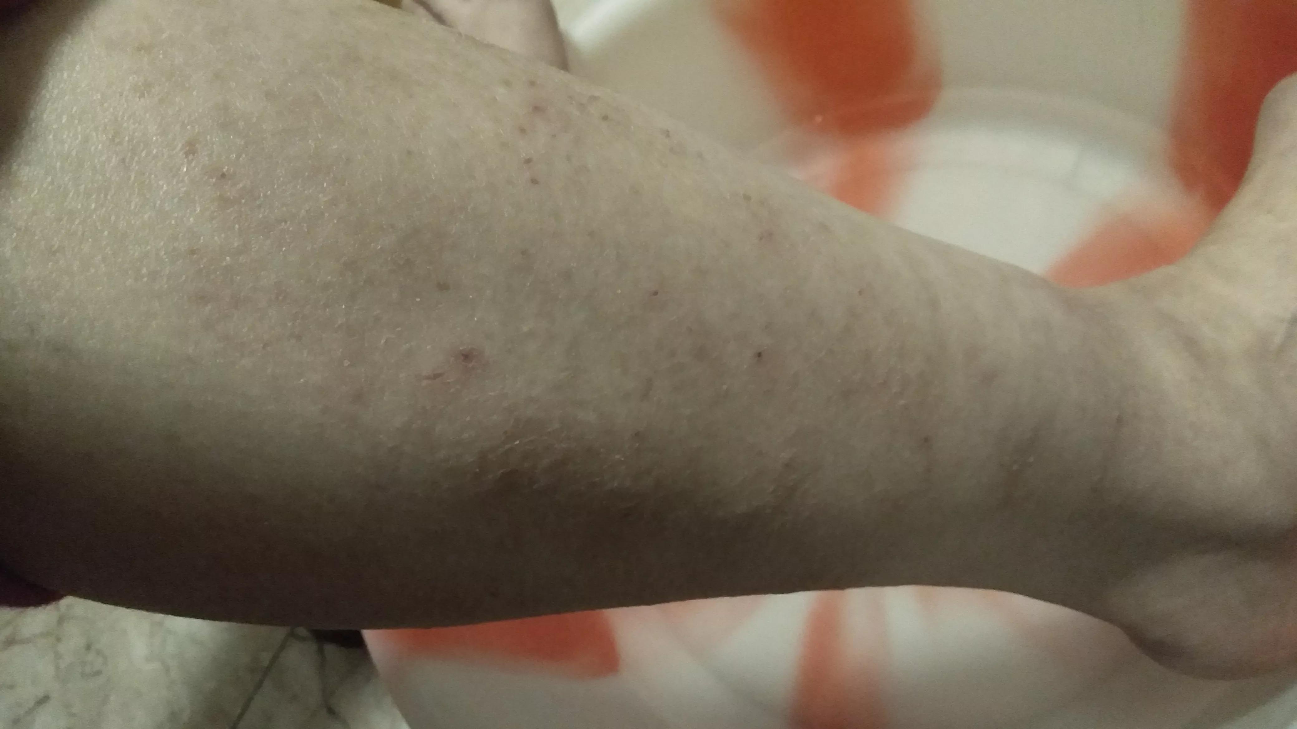 我湿疹复位以后还晕吃什么药,我湿疹怎么是一圈一圈的