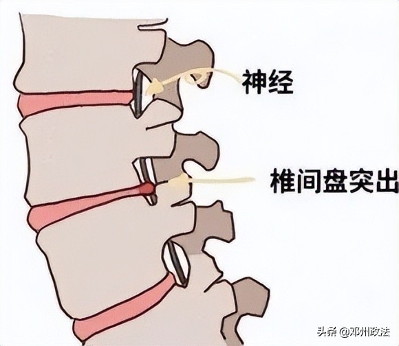 得了腰突就不能上班了吗,腰突不能坐吃什么药