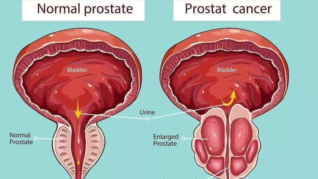 排尿费劲,滴滴答答怎么办?医生为您专业解答