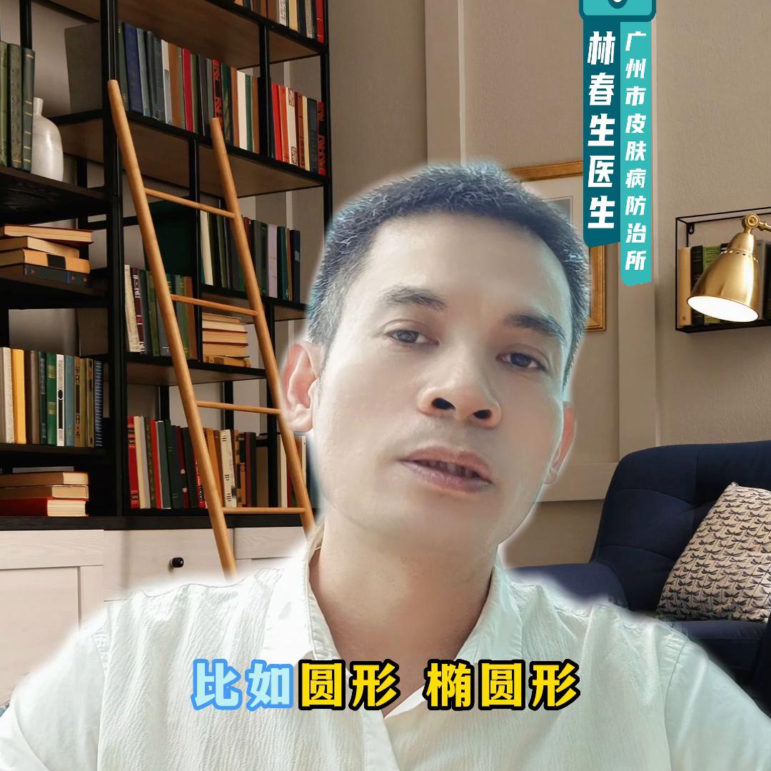 黑色素瘤是一个痣还是很多痣,黑色素瘤和普通的痣有什么区别