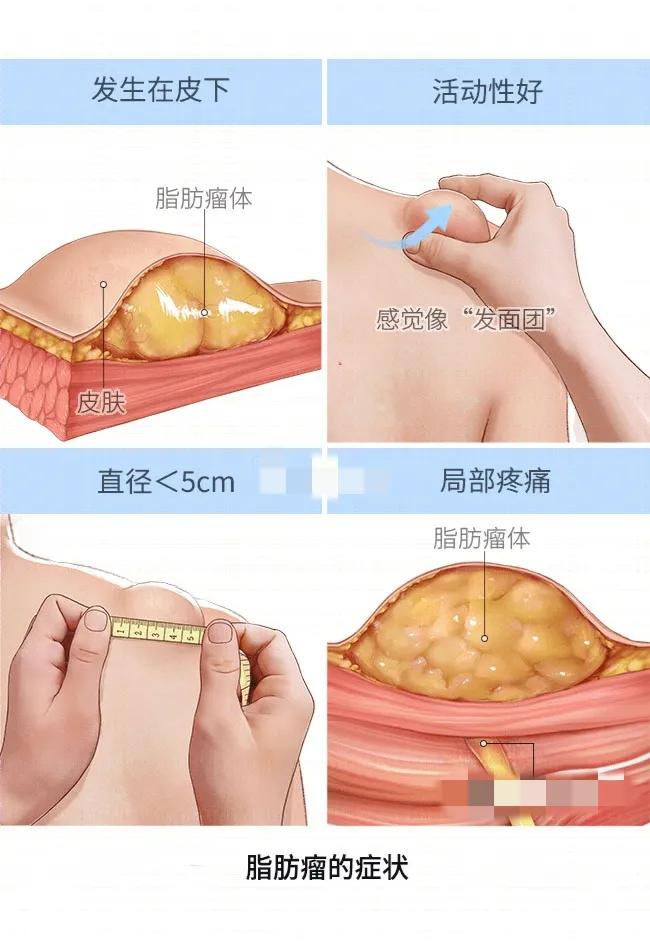 腰部长了一个硬疙瘩像囊肿不疼,腰上长了一个包不痛不痒硬的