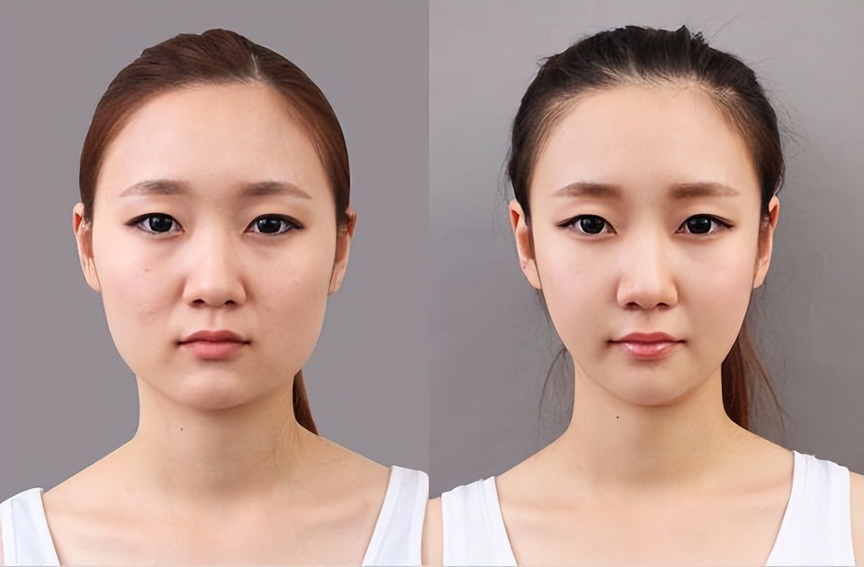 咬肌大反复打瘦脸针还是一直大,打瘦脸针第三天咬肌仍然有力