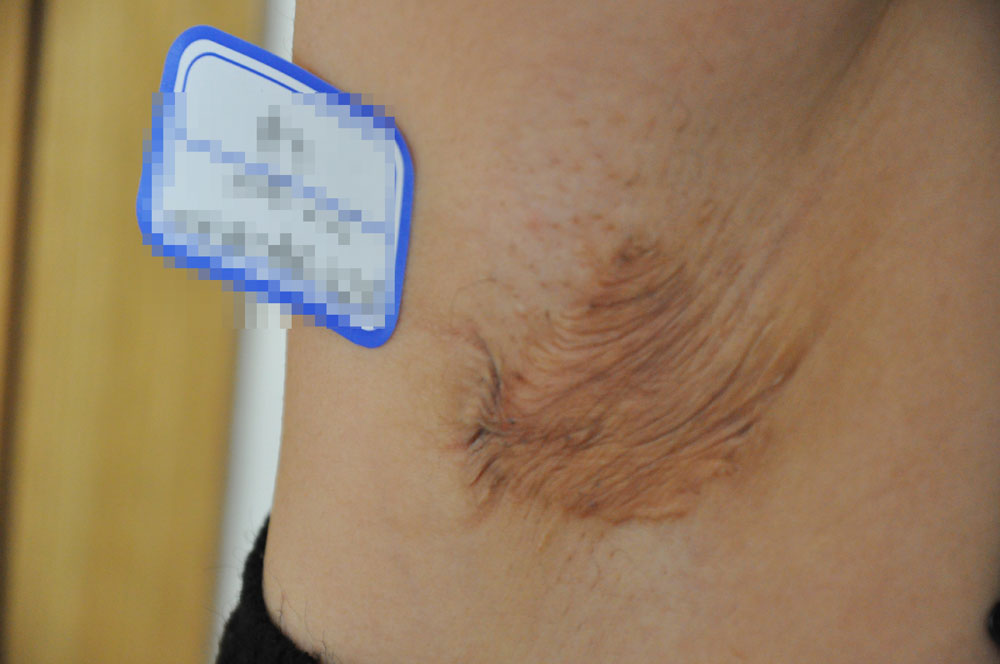 合肥腋下疤痕修复,郑州市疤痕诊疗中心