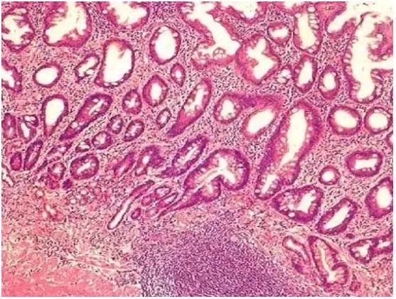 治疗胃肠上皮化生用哪种中药最好,胃化生主要是什么引起的