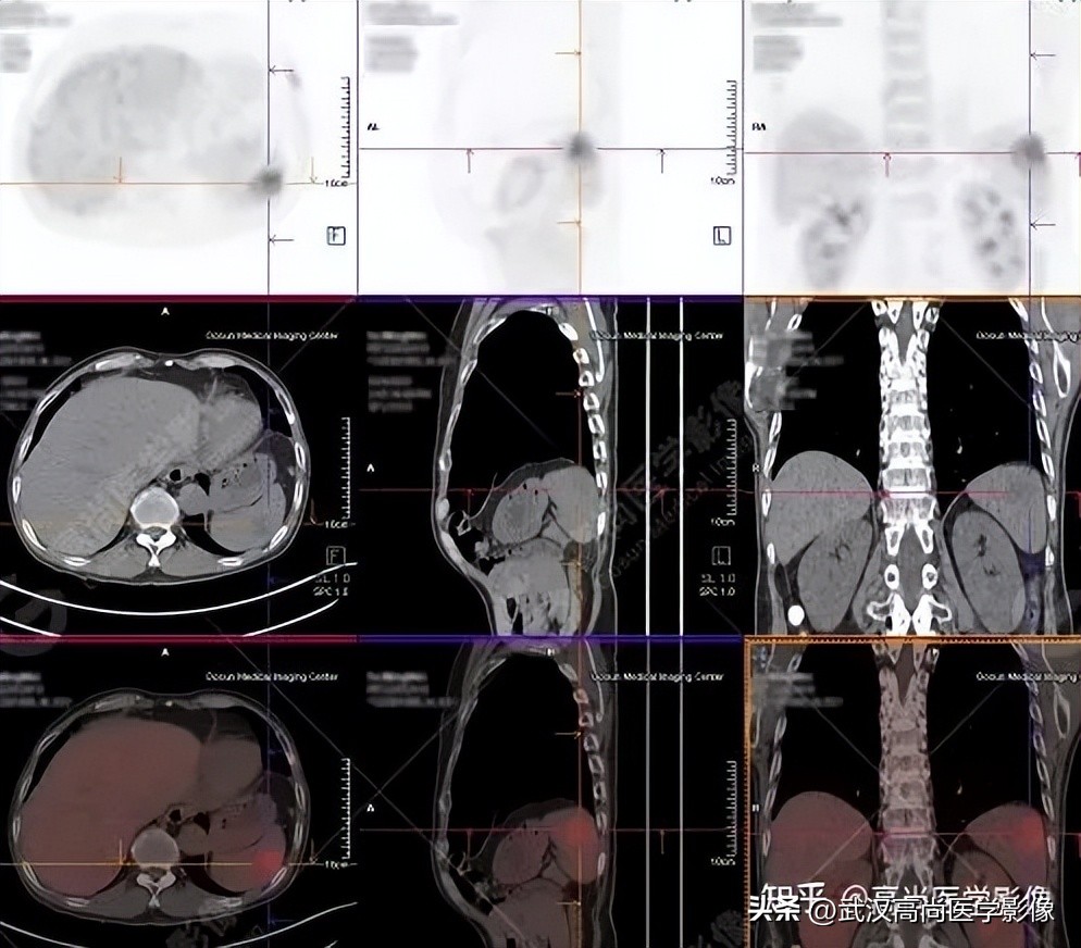 10毫米的肺结节恶性死亡率有多大,1厘米多的肺结节良性可能性多大