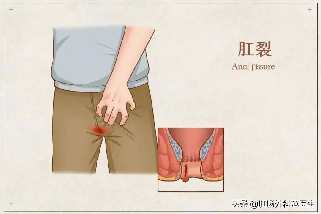 肛裂的治疗目的不包括,肛裂的治疗口服药物