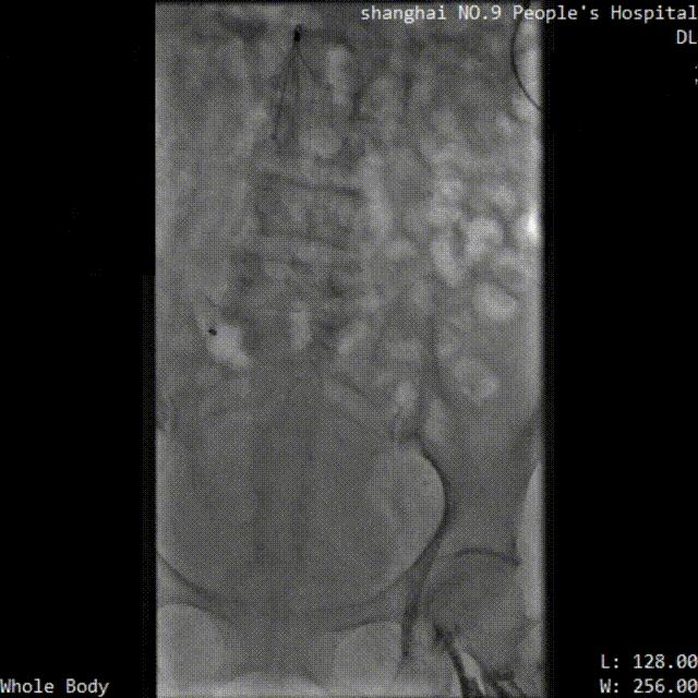 中国医院血栓清除技术,血栓消除的高端技术